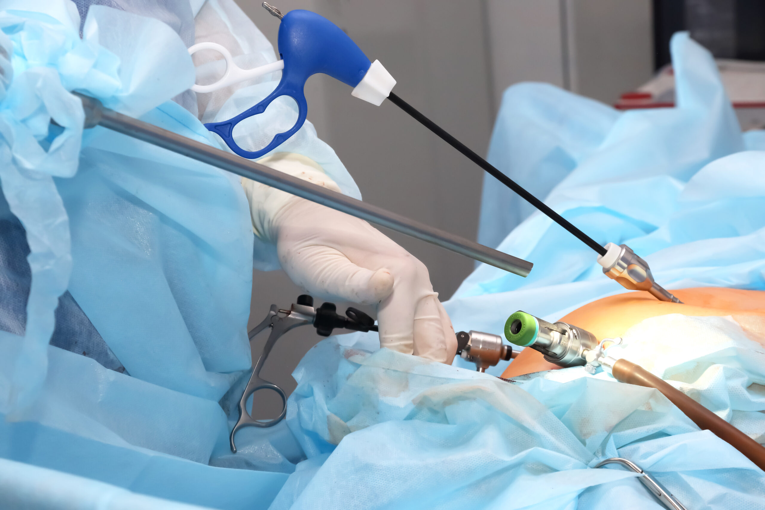 gynae laparoscopic surgery Best Gynae Laparoscopic Surgeon in Old Palasia, Indore